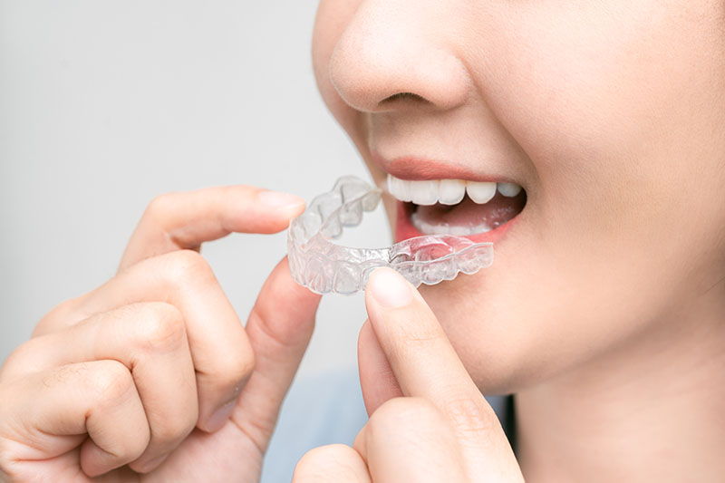 Clear Aligners in Alexandria