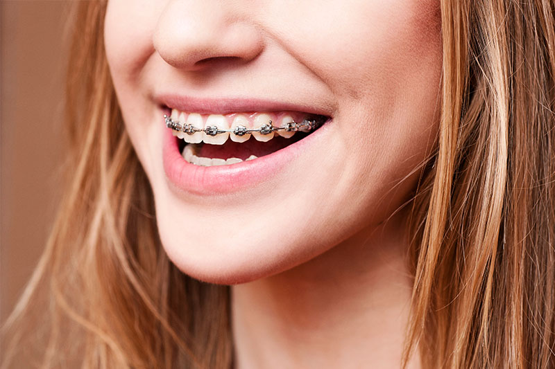 Orthodontics in Alexandria